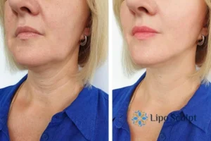 Double chin before and after Hi-Fu treatment 4 Book your double chin treatment Farnham today! We are here to help!