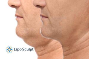 Double chin before and after Hi-Fu treatment 2 Double chin treatment Farnham from Lipo Sculpt - feel more confident today!
