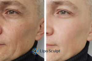 How to Fight Aging Symptoms 3 Fight Aging Symptoms Farnham With HIFU and Morpheus8 Today!