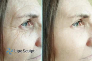 How to Fight Aging Symptoms 2 Do you want to Fight Aging Symptoms Farnham? Contact Lipo Sculpt today!