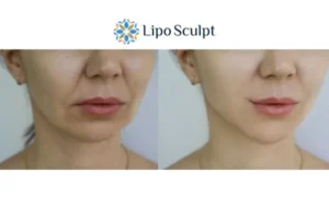 Explaining Total Skin Tightening Treatment And What It Can Do For You 2 Do you want to boost your self confidence? Give Morpheus8 Farnham a try today!