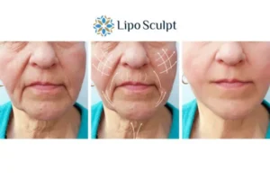Explaining Total Skin Tightening Treatment And What It Can Do For You 3 Boost your confidence with Morpheus8 Farnham call our team today!