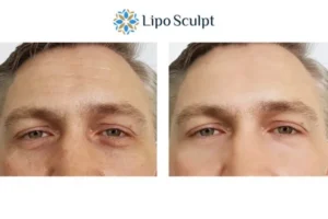 Explaining Total Skin Tightening Treatment And What It Can Do For You 6 Morpheus8 Farnham book in today to find out more!