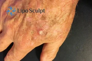 Best Actinic Keratoses Removal 2 Improve your wellbeing and health with Actinic Keratoses Farnham removal.treatment