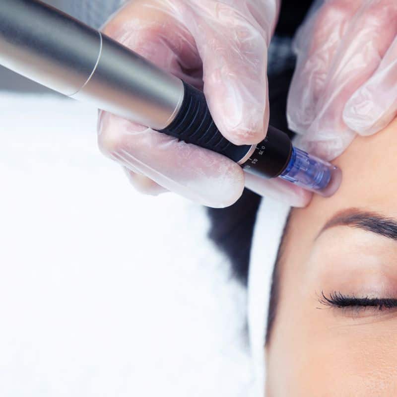 Morpheus8 treatment Farnham from Lipo Sculpt - Book in today!