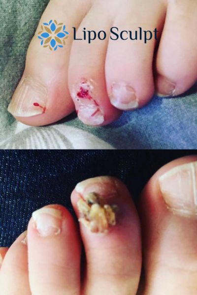 Wart removal customer results from Lipo Sculpt Farnham