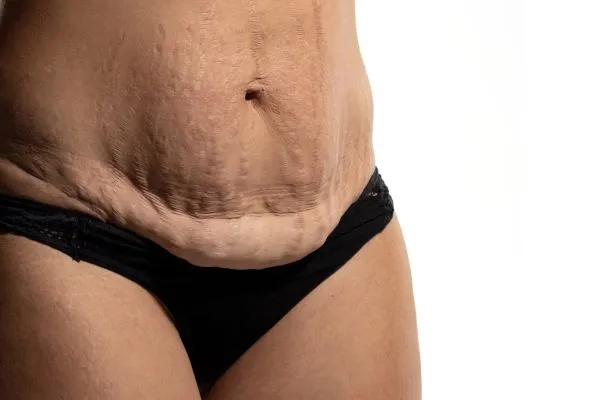Lost the Weight but Not the Loose Skin? 1 image of womans stomach after weight loss showing loose skin Farnham